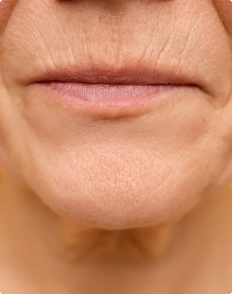 Lip filler in Chandler Az - Revana Medspa